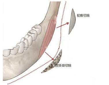 下颌角切除一般多少钱