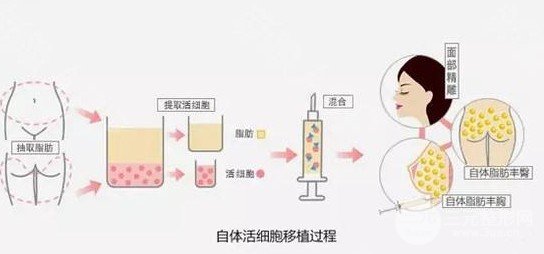面部脂肪填充费用