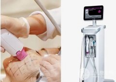 热玛吉的真实果：分享热玛吉左右脸果对比