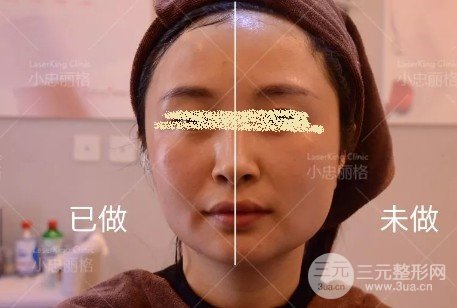 每年做热玛吉会保持年轻吗