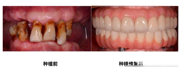 海南国雅口腔医院是公立吗医生信息种植牙案例对比