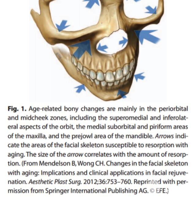 A型注射瘦脸与填充剂在面部美容中的联合应用总结