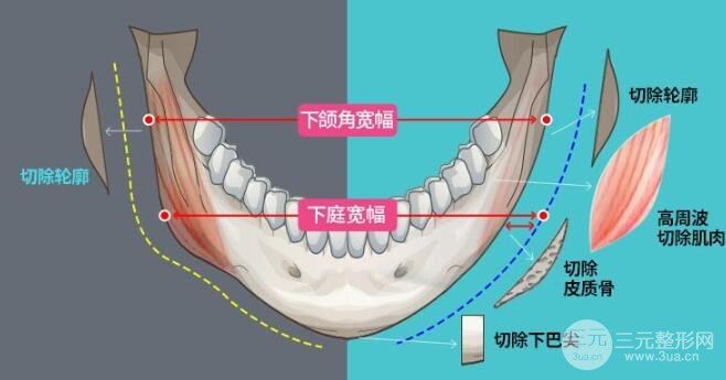 磨骨需要多少钱呢？影响因素有哪些？