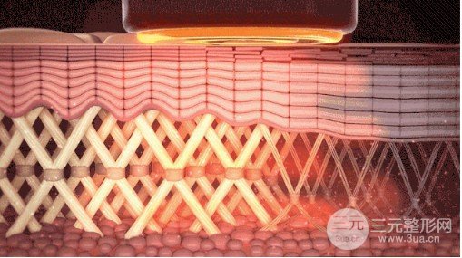 新一代热玛吉900发多少钱