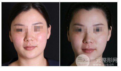 新一代热玛吉900发多少钱