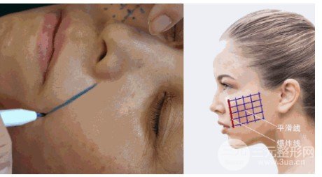 埋线除皱和热玛吉哪个后期果好