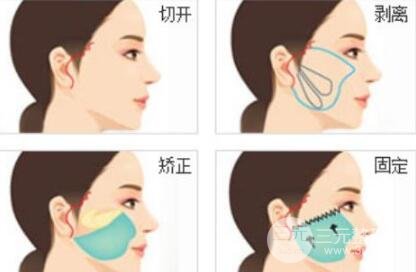 热玛吉和拉皮手术的区别