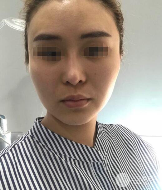 体验热玛吉果反馈