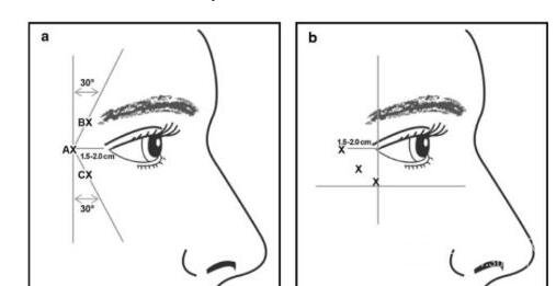 (图3眼角纹注射点a，AX、BX、CX分别为3个注射点;b，皱纹在眼角以下时所取的注射点)