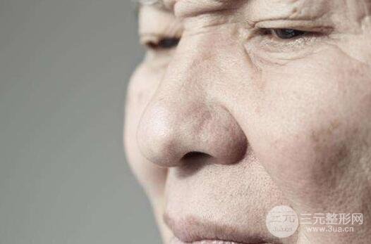 鱼尾纹的成因: