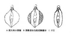 小阴唇整形手术的必要性：感觉痛就该注意了