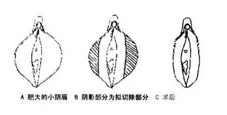 小阴唇整形手术的必要性