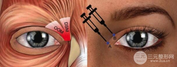 图2 BoNT-A注射示意图;眼轮匝肌及降眉肌频繁收缩时内眦增生性疤痕的主要原因
