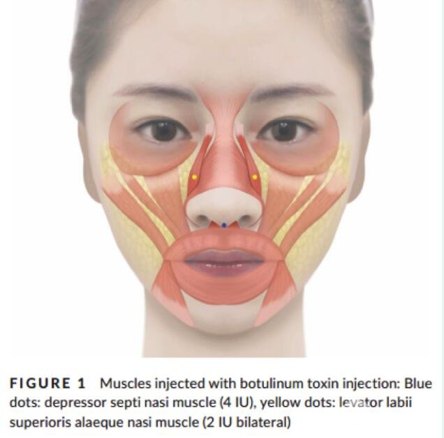 图2 BoNT-A注射降鼻中隔肌及双侧提上唇鼻翼肌改良鼻部对称性示意图(蓝点为降鼻中隔肌，黄点为提上唇鼻翼肌)