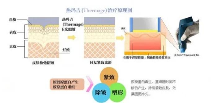 热玛吉的恢复期
