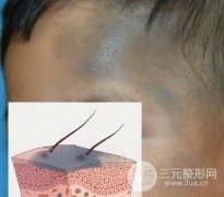 [科普]太田痣是怎么产生的?又是怎么缓解好的?