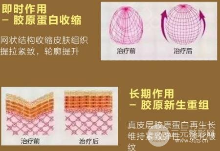 热玛吉的果真的那么好吗