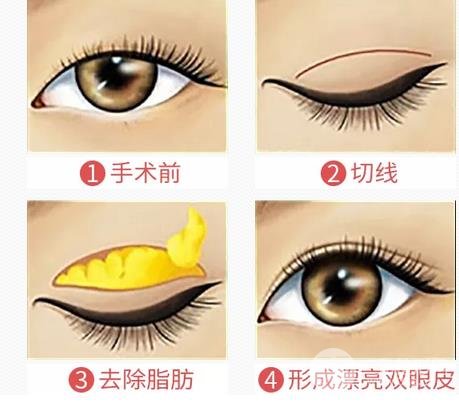 割双眼皮几种常见问题