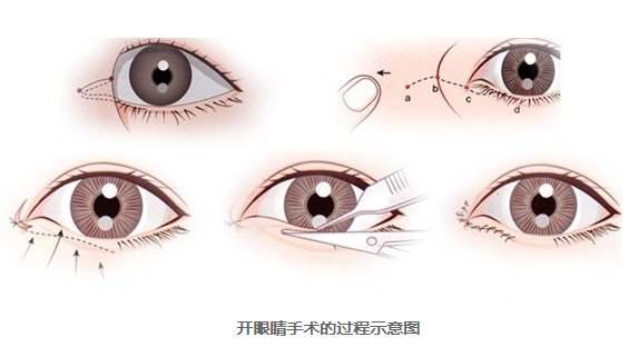 开眼角过程示意图