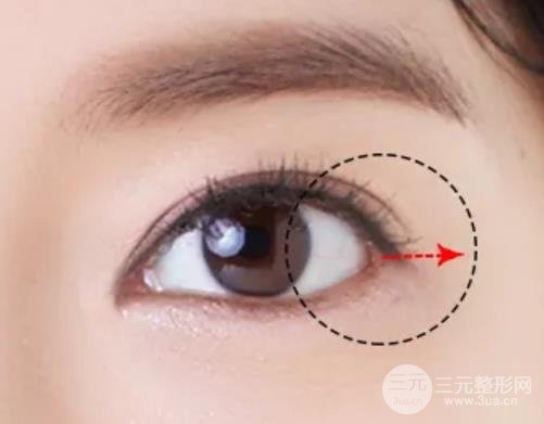 开眼角禁忌人群