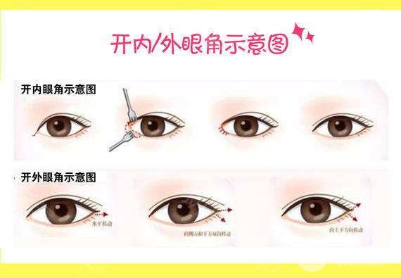 开眼角有什么好处