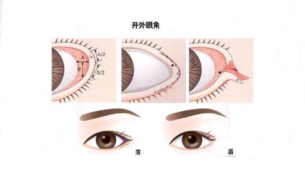 开眼角需要多少钱