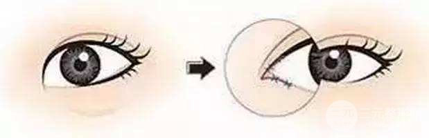 开眼角手术多久能恢复