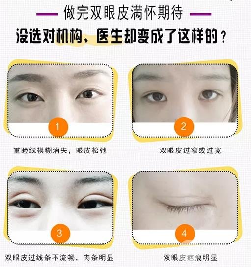 切开双眼皮修复需要多少钱