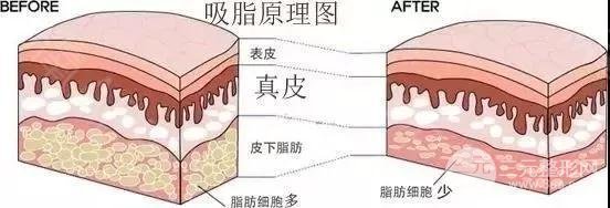 吸脂瘦大腿肿胀期是多久?