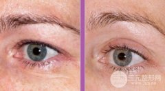眼部热玛吉果图片，还原昔日眼部神采