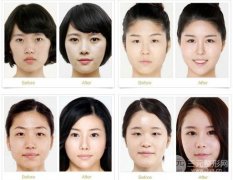 害怕!开眼角有风险吗？为啥都劝别开眼角?