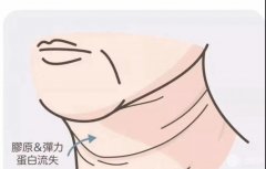颈部注射除皱:嗨体去颈纹,帮你藏好年龄的秘密! 颈部注射除皱:嗨体去颈纹,帮你藏好年龄的秘密!