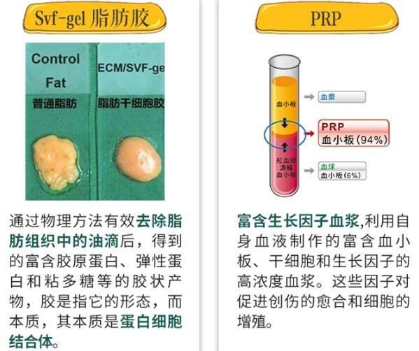 自体隆胸手术