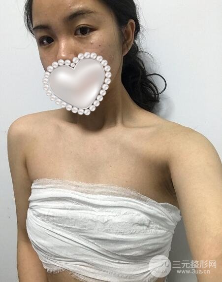 自体隆胸术后