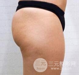 吸脂前