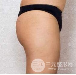 吸脂后