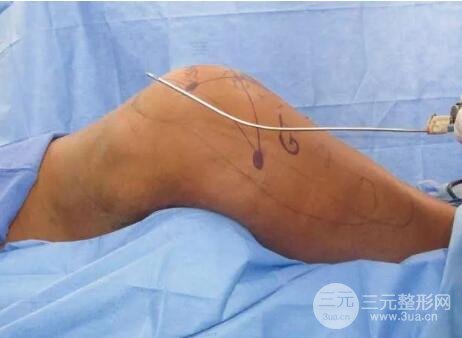 吸脂手术