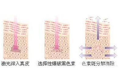 激光美白的原理