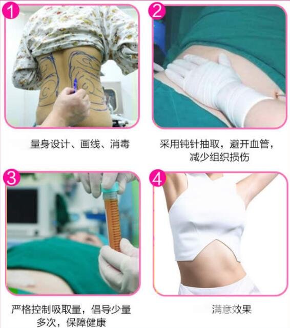 吸脂过程