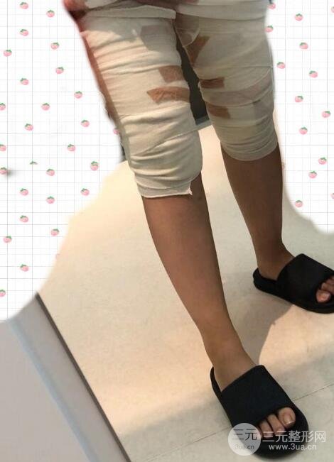 吸脂术后
