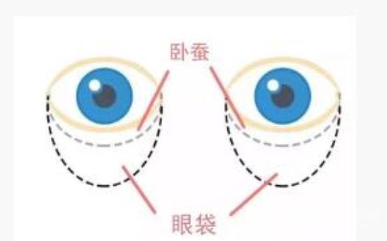 祛眼袋手术果可以维持多久?