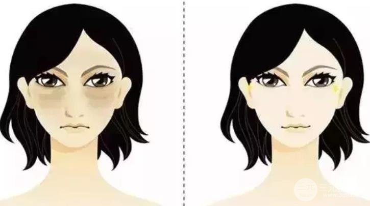 祛眼袋手术会反弹吗