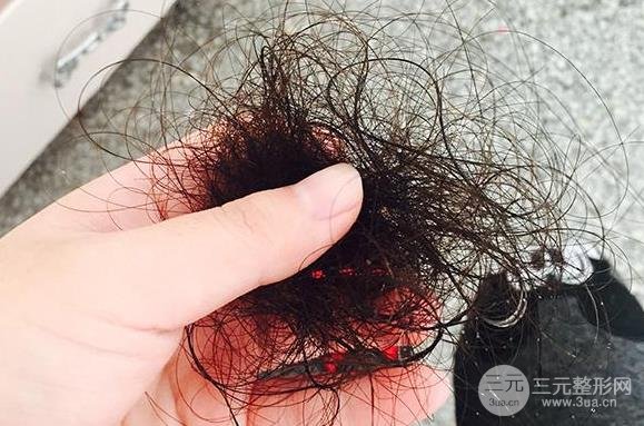 植发际线费用多少钱