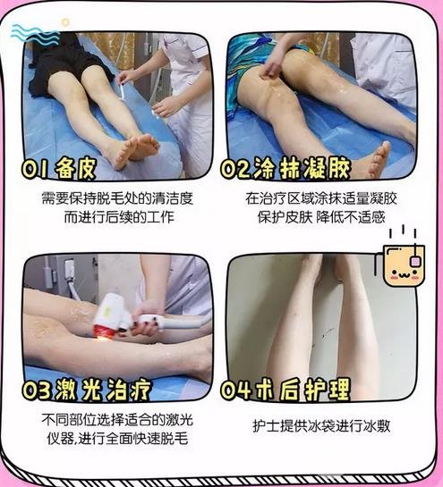 激光脱毛有副作用吗