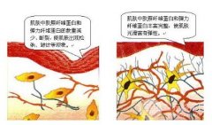 胶原蛋白填充和玻尿酸填充哪个好?试试联合缓解吧!