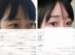 内双割双眼皮果图片，决定手术成功的几点因素