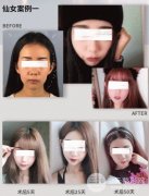 额头填充术对比图片，用玻尿酸还是脂肪填充更好?