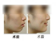 整酒窝对比照片—酒窝成形方法及副作用揭秘