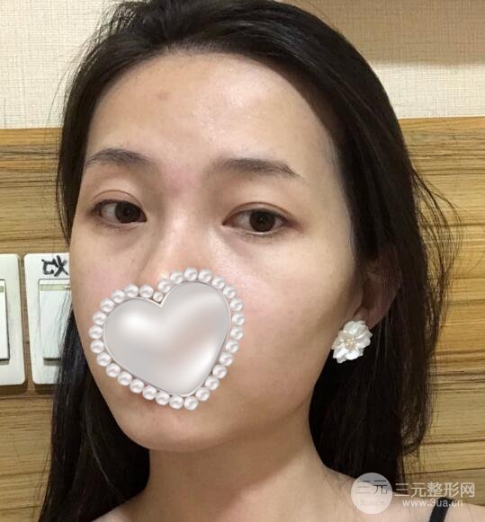 注射瘦脸术前