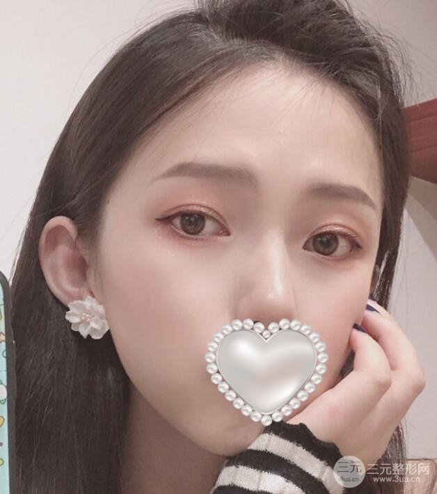 注射注射瘦脸术后